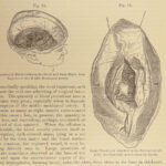 1882 GROSS Anatomy & Surgery System Medicine Pathology Therapy Engraving 2v Set