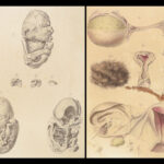 1829 Anatomy & Pathology ATLAS 86 Color Illustrated Disease Cruveilhier Medicine