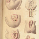 1829 Anatomy & Pathology ATLAS 86 Color Illustrated Disease Cruveilhier Medicine