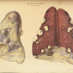 1829 Anatomy & Pathology ATLAS 86 Color Illustrated Disease Cruveilhier Medicine