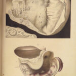 1829 Anatomy & Pathology ATLAS 86 Color Illustrated Disease Cruveilhier Medicine