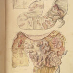 1829 Anatomy & Pathology ATLAS 86 Color Illustrated Disease Cruveilhier Medicine